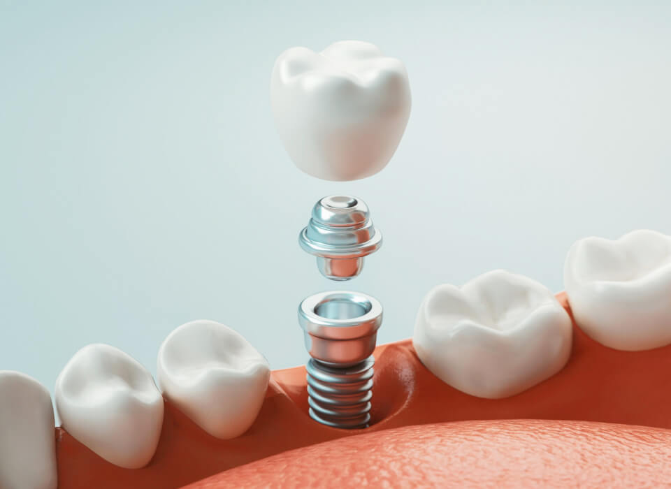 An arrangement of dental implants alongside dental crowns, highlighting their role in tooth restoration and aesthetics.
