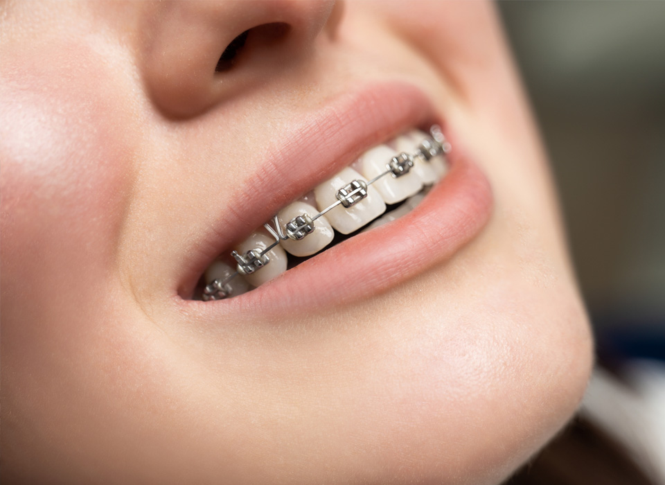 Close-up of a woman's smiling mouth with metal dental braces on her teeth