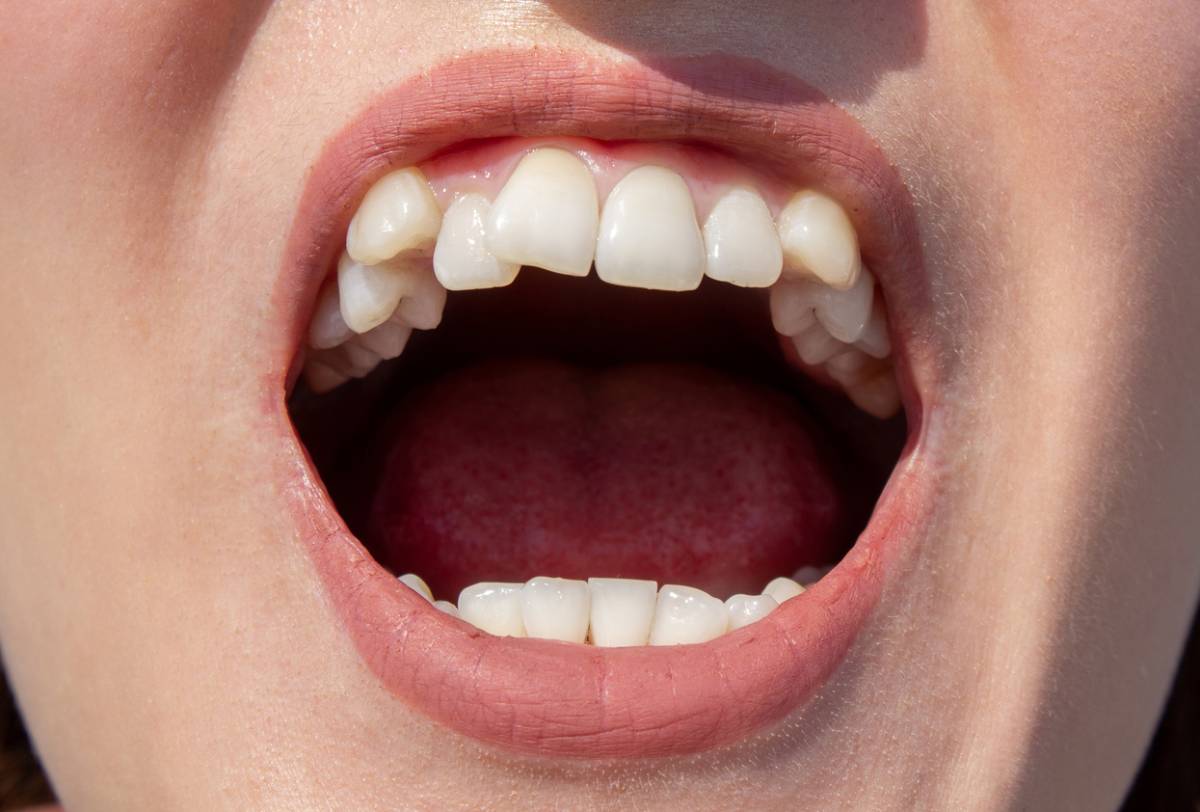 Featured image for How Long Does Invisalign Take to Correct Smile Misalignment?