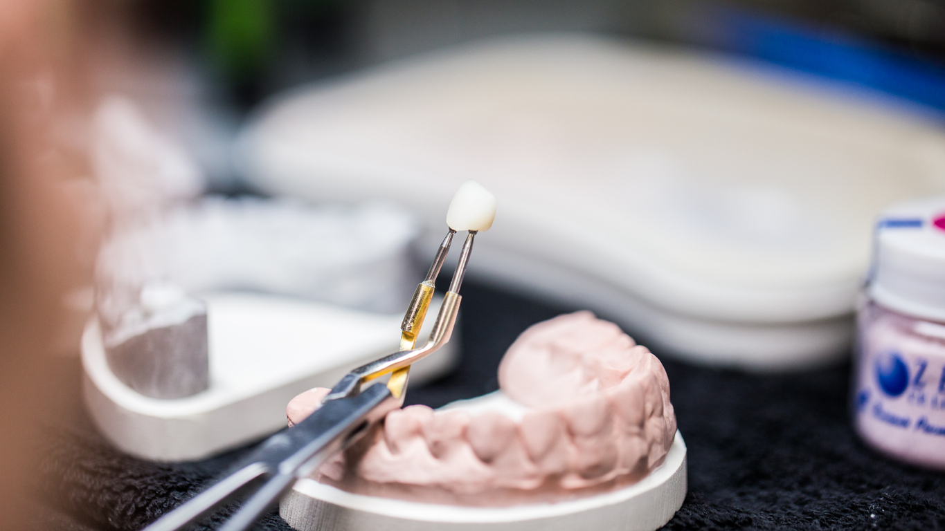 A dental technician carefully holds a crafted dental crown using tweezers over a model of teeth in a professional laboratory environment, illustrating precision in restorative dentistry.